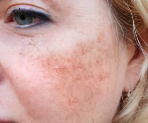 Pico Laser Treatment for Skin Discoloration: Get the Glow You Deserve