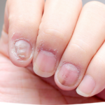 Nail Fungus