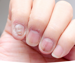 Understanding Nail Fungus: Top Treatment Option for Healthy Nails