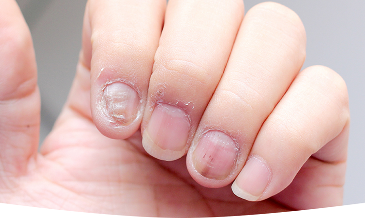 Nail Fungus