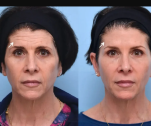 Sculptra Fillers in Dubai: How They Work and What to Expect