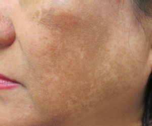 What Treatments Work Best for Dermal Pigmentation Removal?