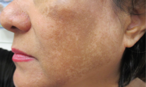 What Treatments Work Best for Dermal Pigmentation Removal
