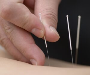 Why Acupuncture in Chennai is the Key to Holistic Healing!