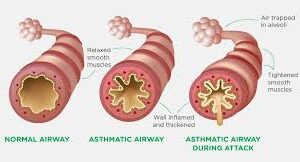 Beat Sniffles: Asthma & Allergy Relief Tips