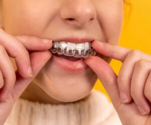 How Clear Aligners for Teeth Work: A Step-by-Step Guide