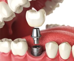 What to Expect During a Dental Implant Procedure