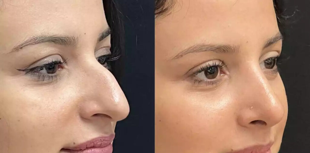 rhinoplasty in dubai
