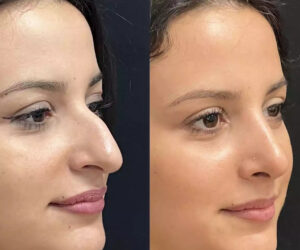 What Recovery Looks Like with the Best Rhinoplasty Surgeon in Dubai