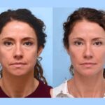 Why Celebrities Choose the Best Aesthetic Clinics in Dubai for Thread Lift Injections