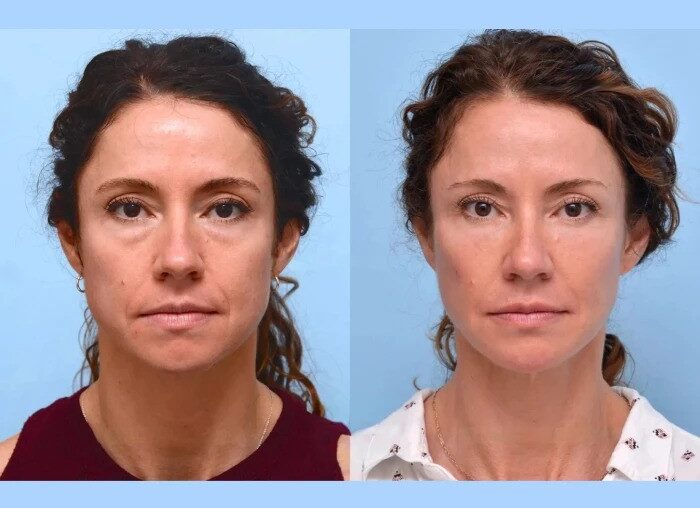 Why Celebrities Choose the Best Aesthetic Clinics in Dubai for Thread Lift Injections
