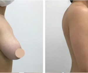 What to Expect from Your Breast Lift Results in Dubai
