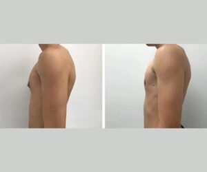 Gynecomastia Before and After: Real Patient Results in Dubai