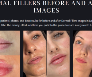 Fillers Treatments in Dubai: Cost Breakdown and Affordable Options