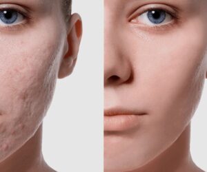 Pico Laser: The New Standard in Skin Care