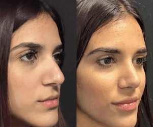 Best Rhinoplasty Surgeon in Dubai for Natural-Looking Results