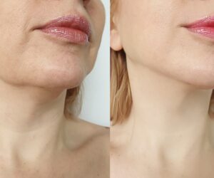 How Double Chin Liposuction Improves Face Shape