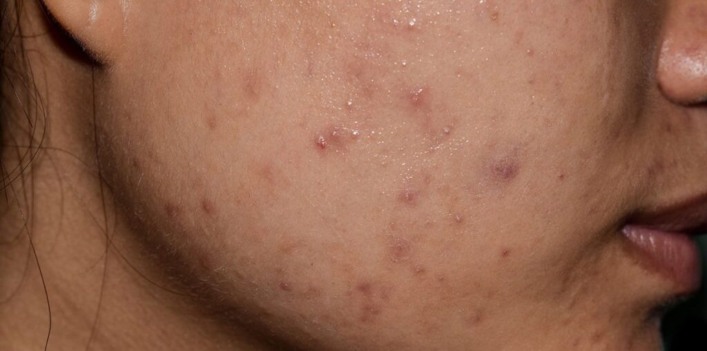 Does Acne Scar Treatment Last Forever?