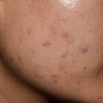 Does Acne Scar Treatment Last Forever?