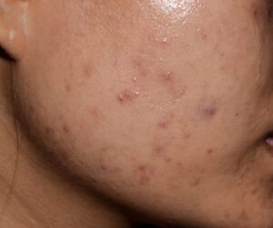 Does Acne Scar Treatment Last Forever?
