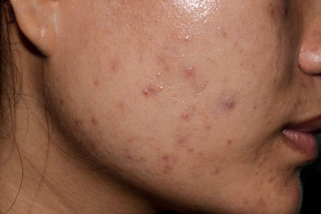 Does Acne Scar Treatment Last Forever?