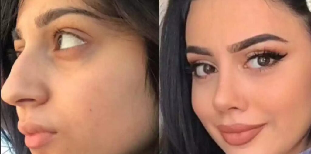 rhinoplasty in dubai