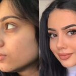 rhinoplasty in dubai