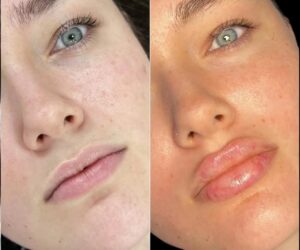 Why the Best Plastic Surgeon in Dubai is Your Best for Perfect Russian Lip Fillers