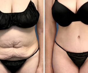 How Much Skin Is Removed in Tummy Tuck?