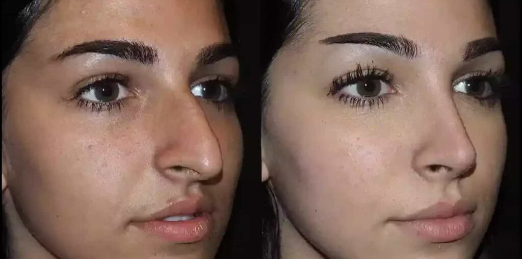 septoplasty in dubai