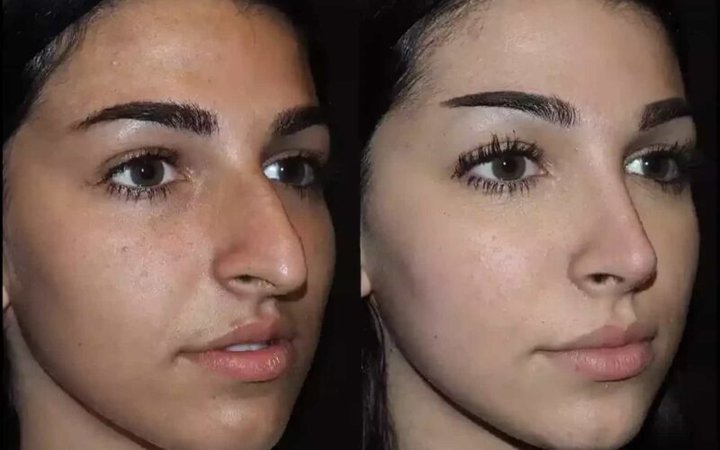 Your Guide to the Best Doctors in Dubai for Nasal Septum Surgery