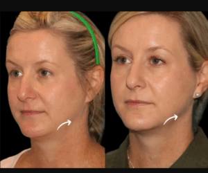 What to Expect Before and After Your Sculptra Fillers in Dubai Treatment