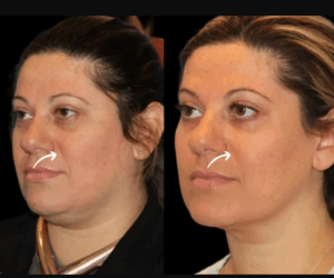 Can Sculptra Fillers Lift Sagging Jowls? Dubai Best Plastic Surgeons Answer
