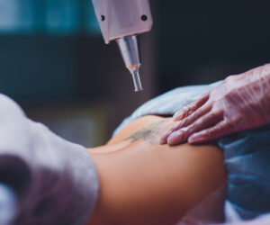 Tattoo Removal for All Skin Types