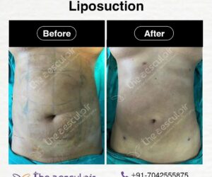 Discover Affordable Liposuction Surgery Cost in India with the Best Plastic Surgeon at Theaesculpir