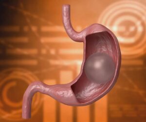 Gastric Balloon Placement that Works