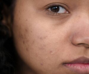 Microneedling for Acne Scars: A Game-Changer for Skin Renewal