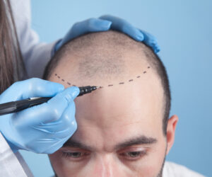 How long does Front Line Hair Fixing last?