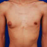 How to Tell If You Have Gyno: Signs, Symptoms, and What to Do Next