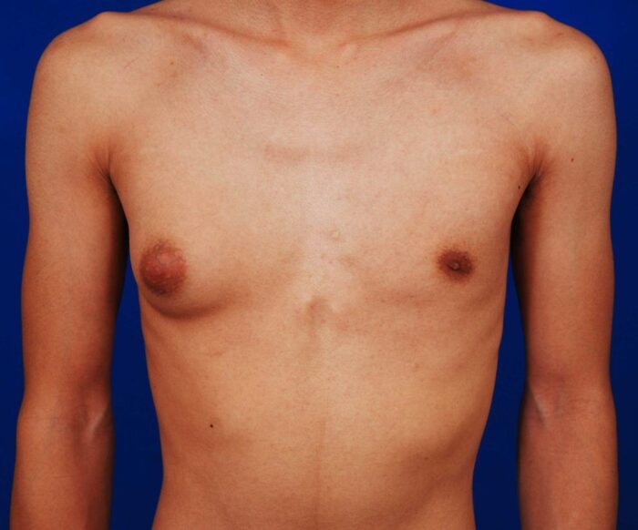 How to Tell If You Have Gyno: Signs, Symptoms, and What to Do Next